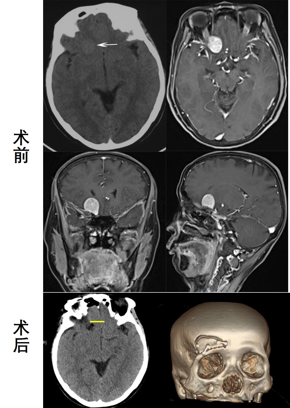 眶上鎖孔眉弓入路切除前顱窩底腦膜瘤