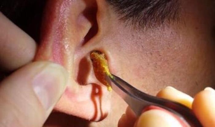 带你正确认识耵聍