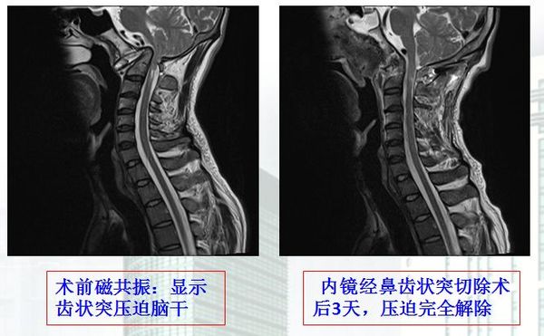 内镜微创治疗颅底凹陷症