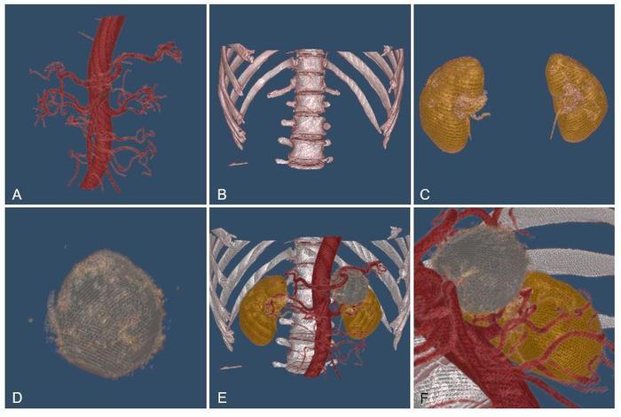 图像可以清晰显示血管供应,周围器官关系通过自主开发的三维影像重建