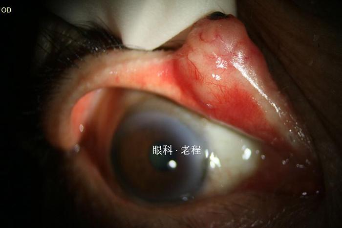 眼睑恶性肿瘤系列之鳞状细胞癌 - 微医(挂号网)
