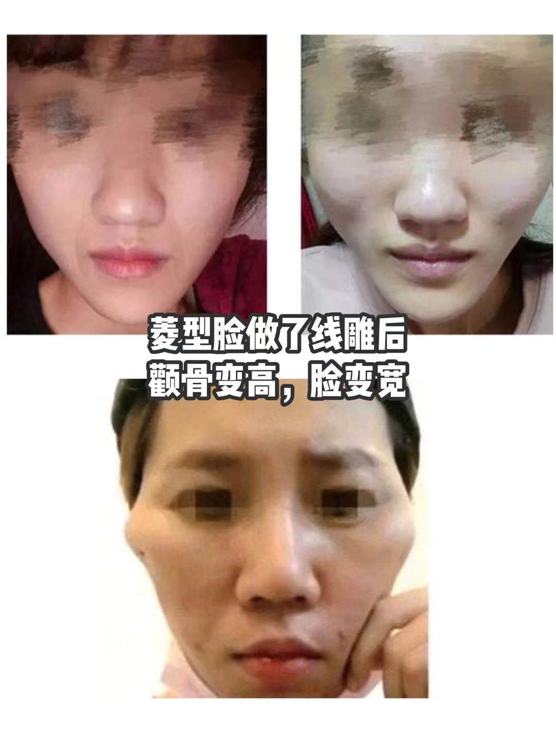 原创很多医生不会告诉你为什么你做了线雕之后脸变大了凹陷了