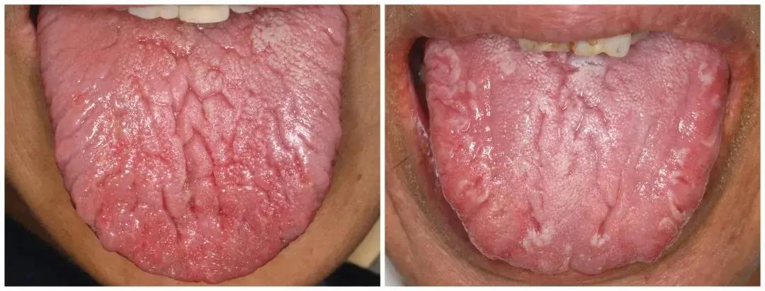 口腔黏膜专家刘海云讲解:中医如何治疗裂纹舌_刘海云医生文章_青海省