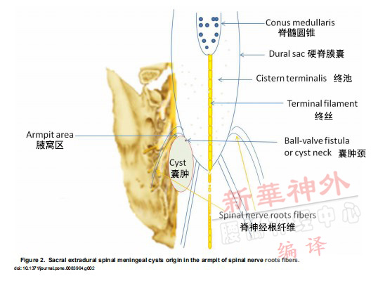 骶管囊肿位置示意图图片