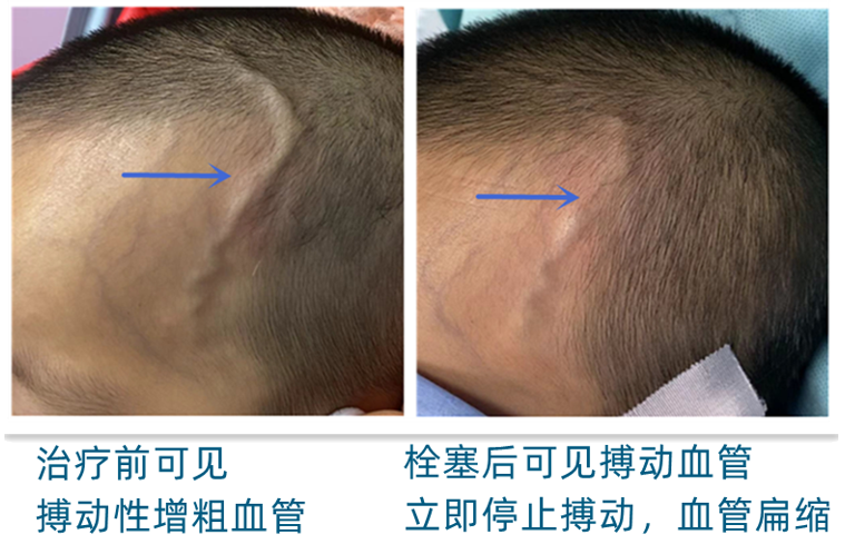 头皮动静脉畸形(动静脉瘘)介入微创治疗病例 - 微医(挂号网)