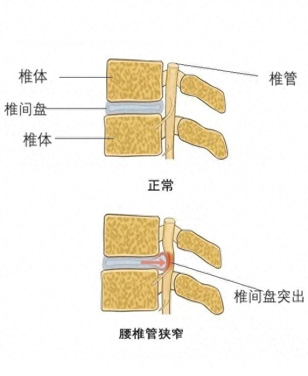 一次查出两种病腰椎间盘突出症和腰椎管狭窄到底有没有关系