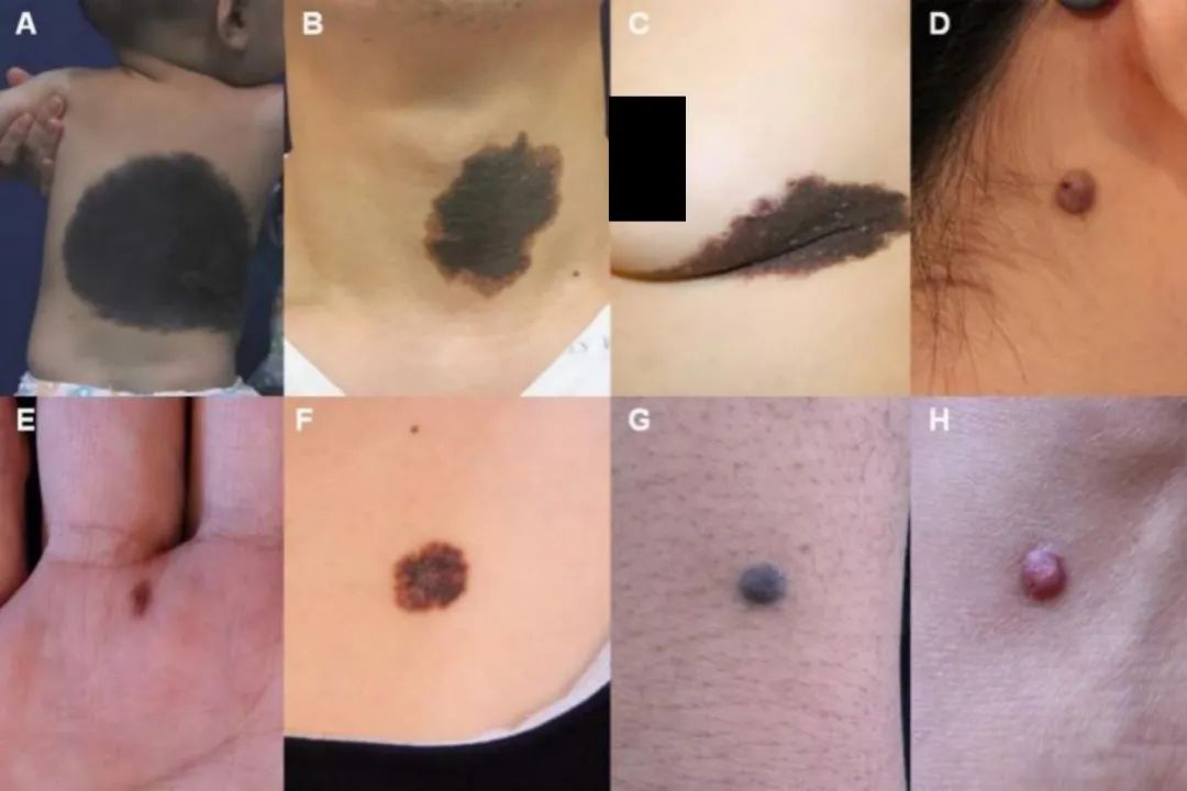 痣及皮肤肿物|父母身上的黑痣会遗传给孩子吗?