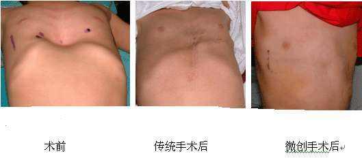 跟"鸡胸"相反,漏斗胸就是胸骨连同两侧肋软骨向内凹陷,形状就好比一个