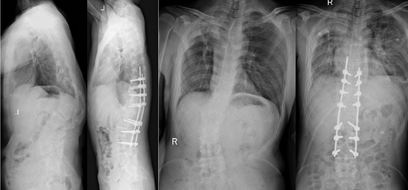 病例分享:脊柱后凸畸形矫形术