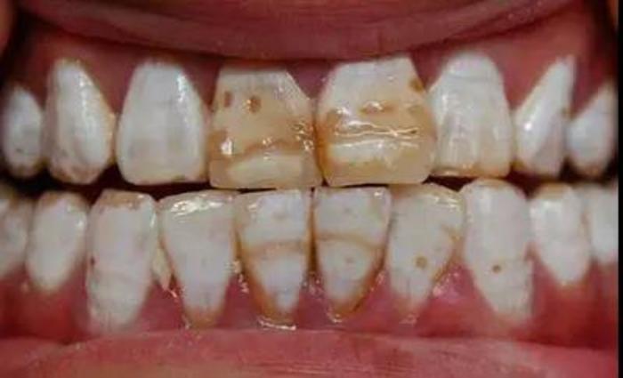 牙齿突然掉了一小块是怎么回事