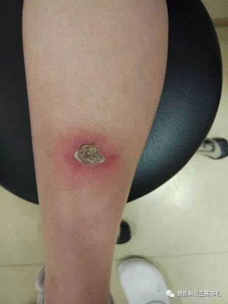 烫了个水疱怎么办