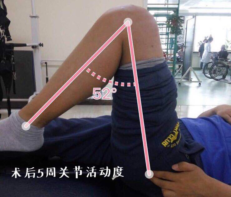 【病例分享】麻醉下手法松解术处理acl重建术后膝关节粘连