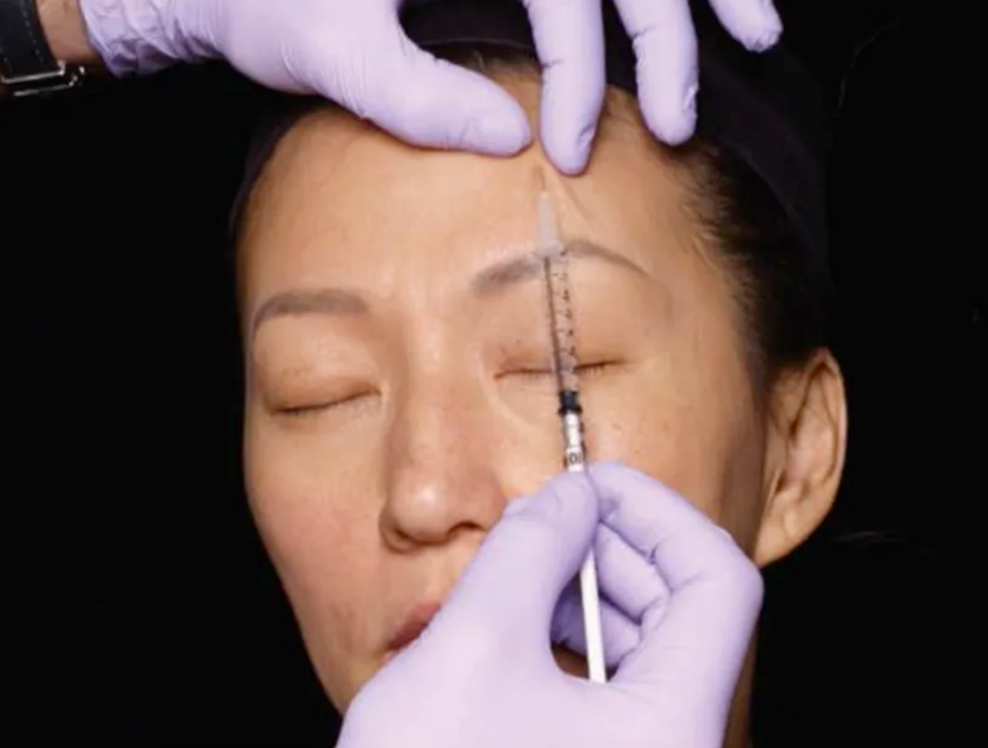 得了面肌痉挛,该打肉毒素吗?