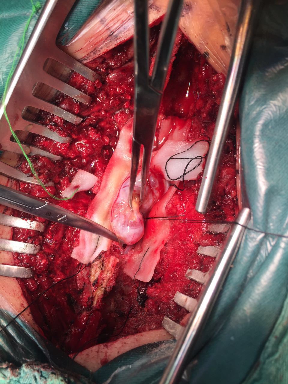 手术切除胸腰段椎管内神经鞘瘤上海肿瘤医院脑脊柱外科