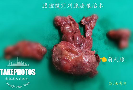 系列科普56年多了巴菲特竟然还活着前列腺癌的奥秘