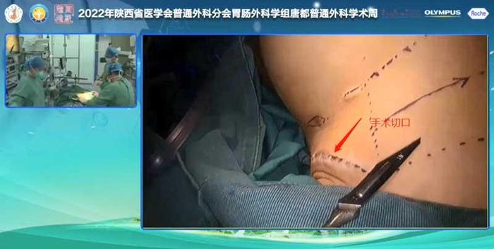 经腋窝入路腔镜下甲状腺左侧叶切除术中央区淋巴结清扫术