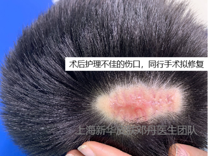 病例系列12皮脂腺痣头皮治疗热门问答