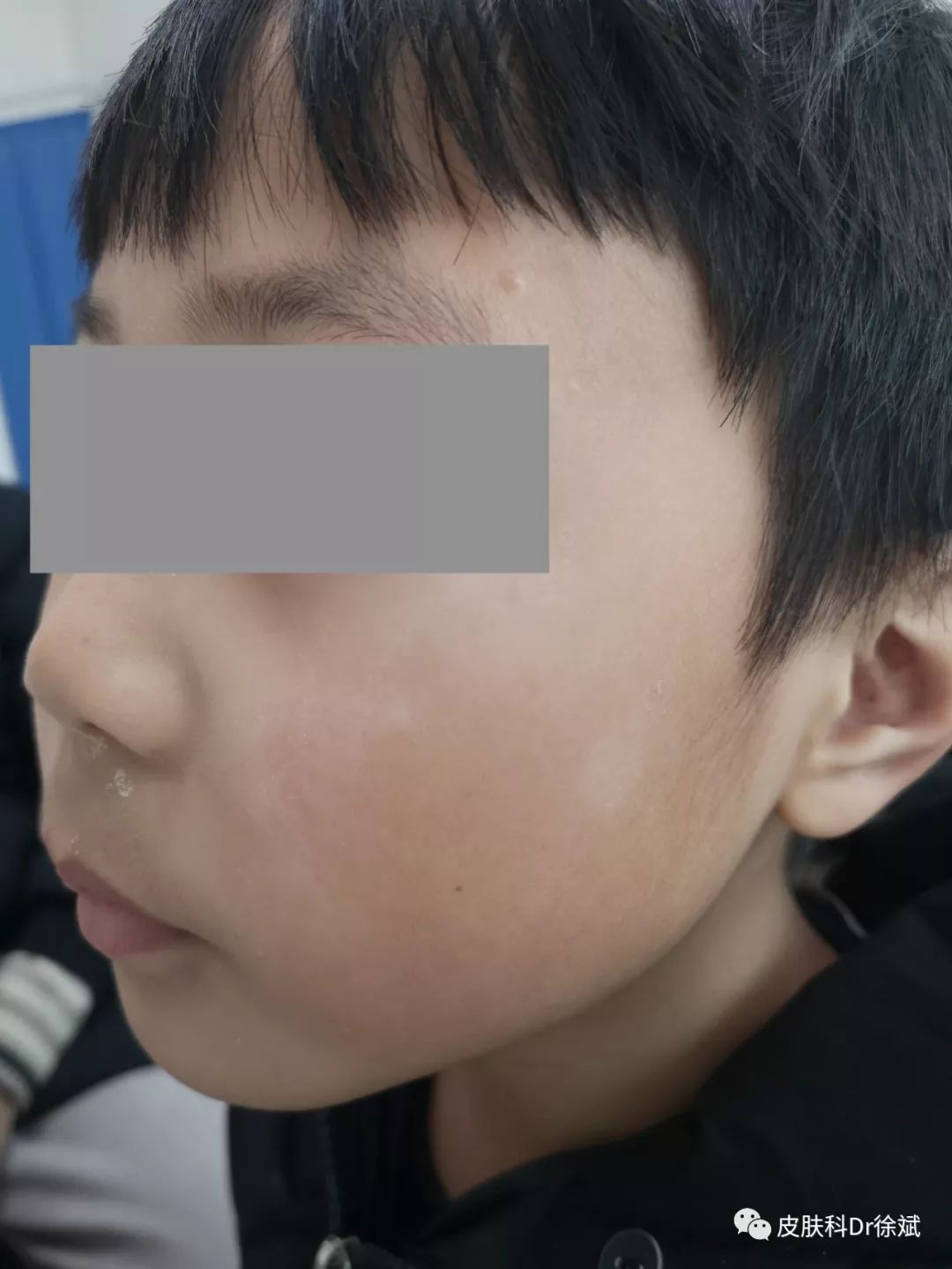 儿童面部白斑怎么办?别慌,可能和白癜风没有半毛钱关系!