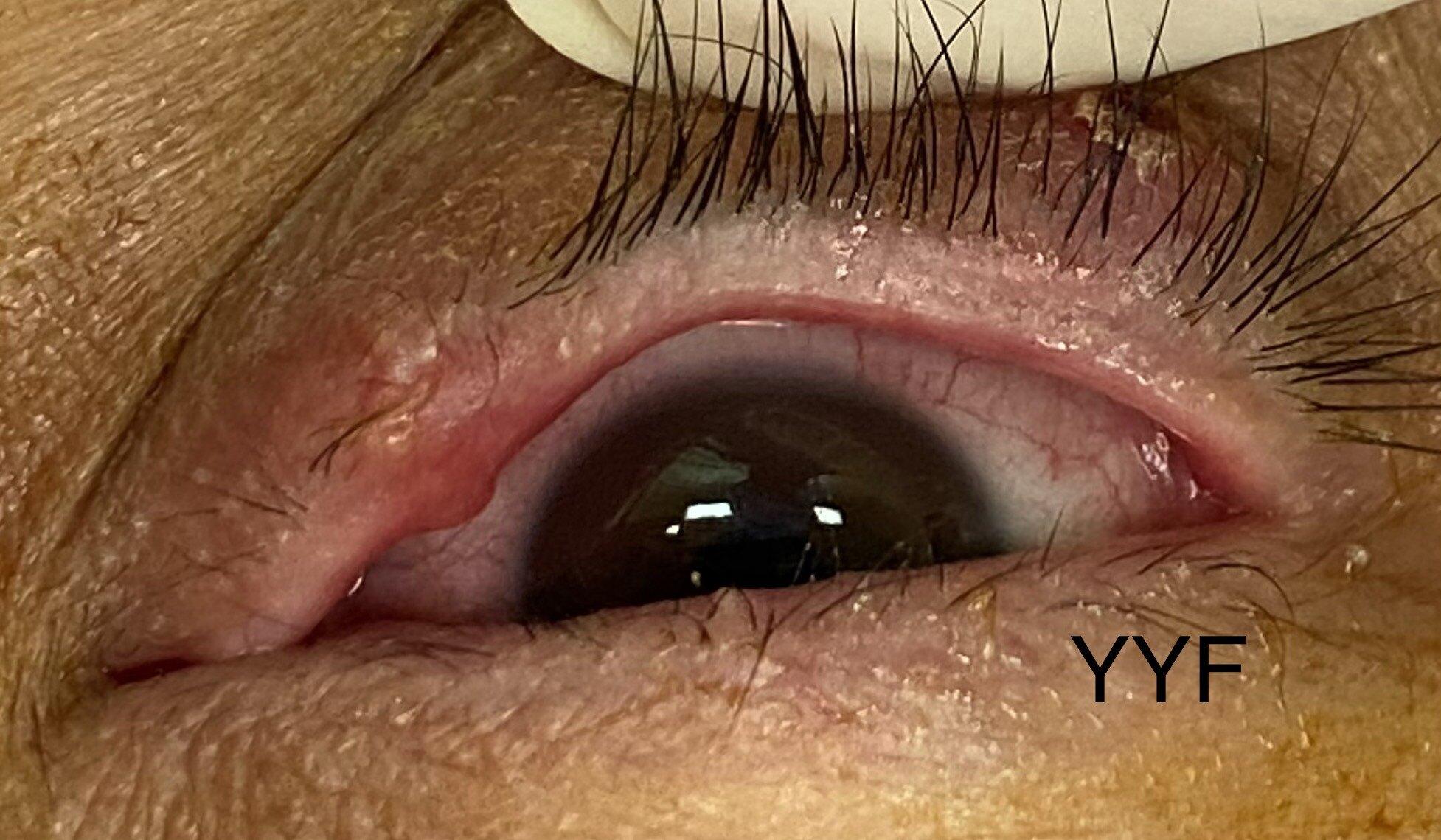 眼睑肿块系列之二睑缘霰粒肿手术宜早不宜迟