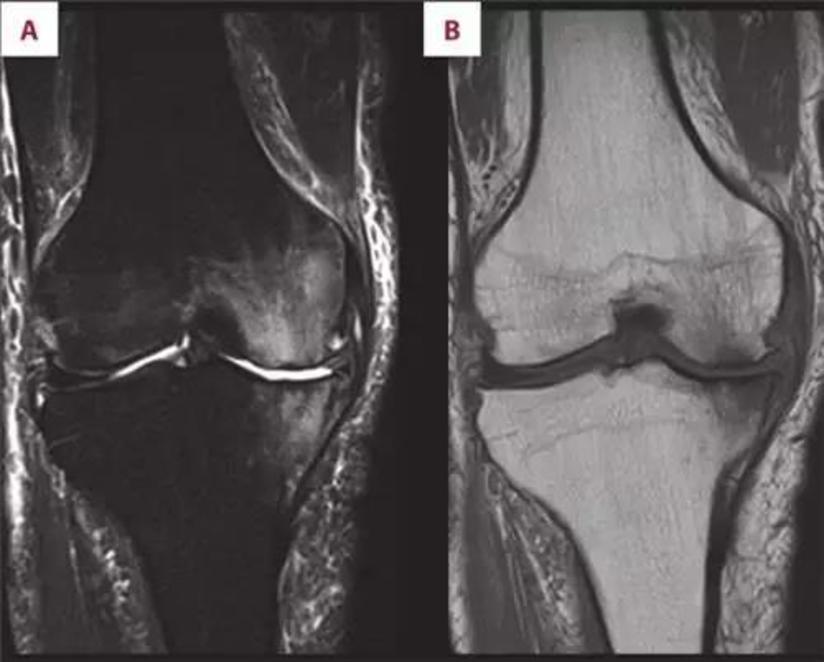 骨关节炎 骨关节炎可能是细微骨折导致的关节疼痛 健康号 微医