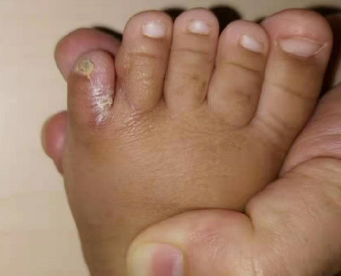 小孩多指伴并趾宝宝脚趾多趾伴并趾可以手术做掉吗