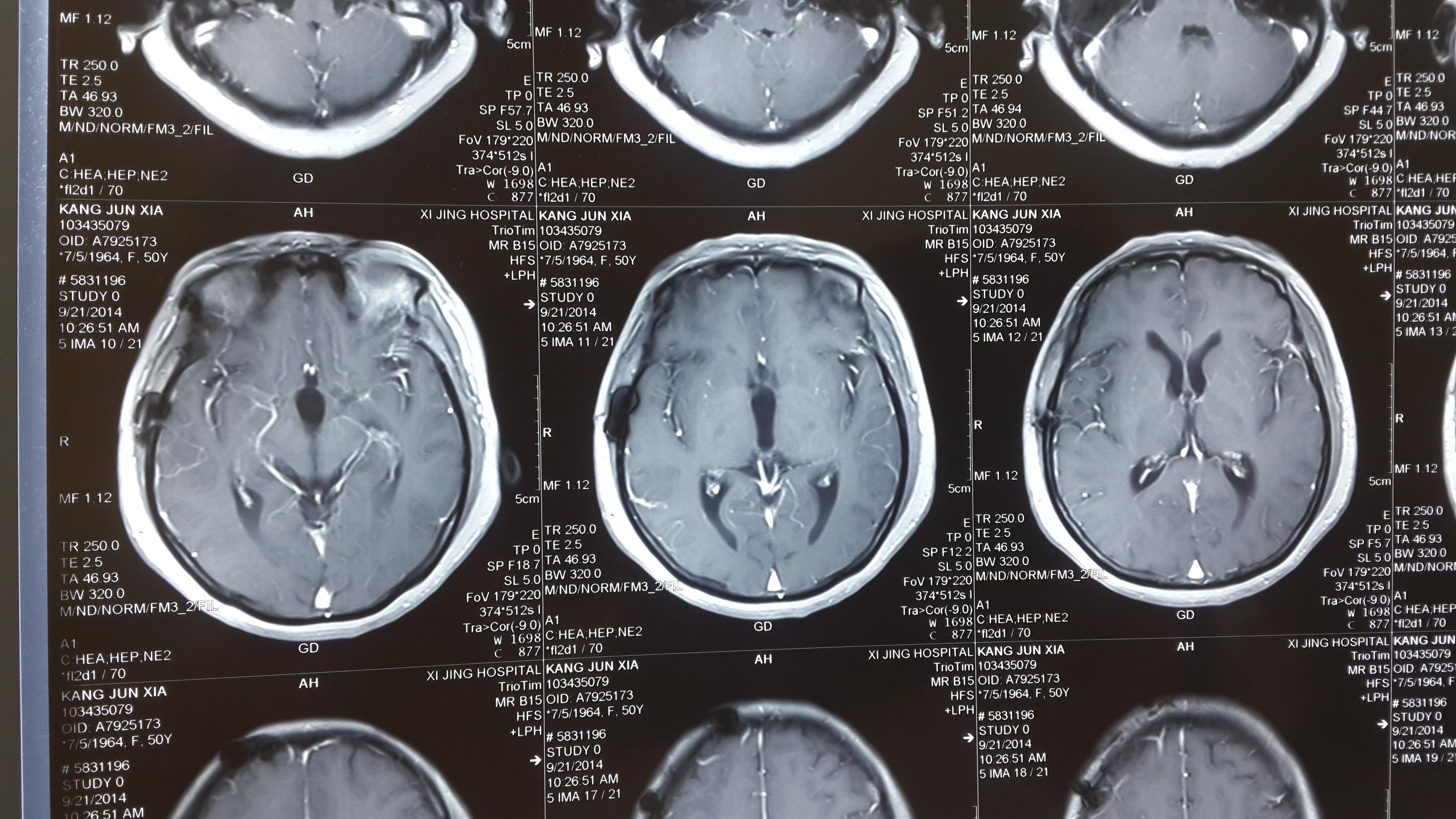 贺晓生教授垂体瘤开颅切除术案例