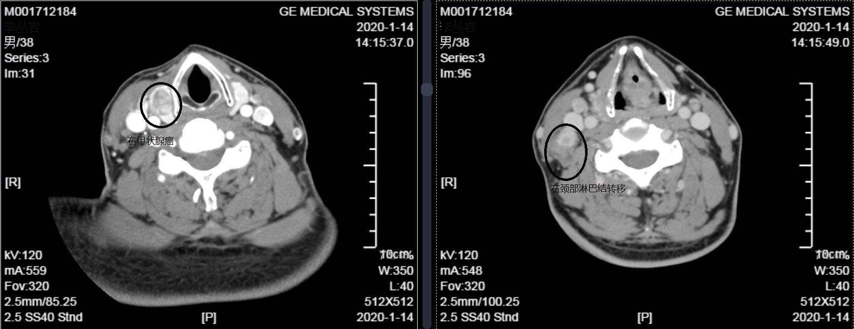 甲狀腺雙側乳頭狀癌雙側頸側區淋巴結轉移可以同時雙側