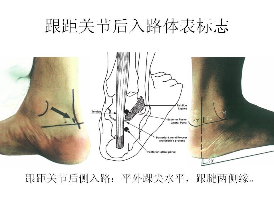 跟距骨解剖图片