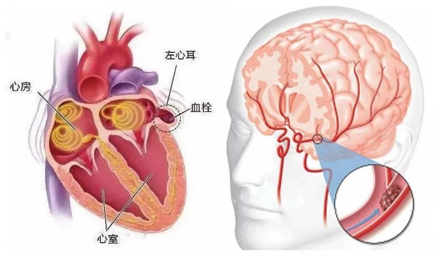 房颤患者的左心耳为什么会形成血栓呢?这与左心耳的结构及功能有关.