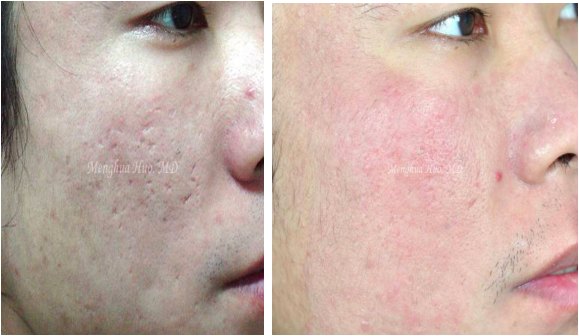 点阵激光fractionallaser的临床应用