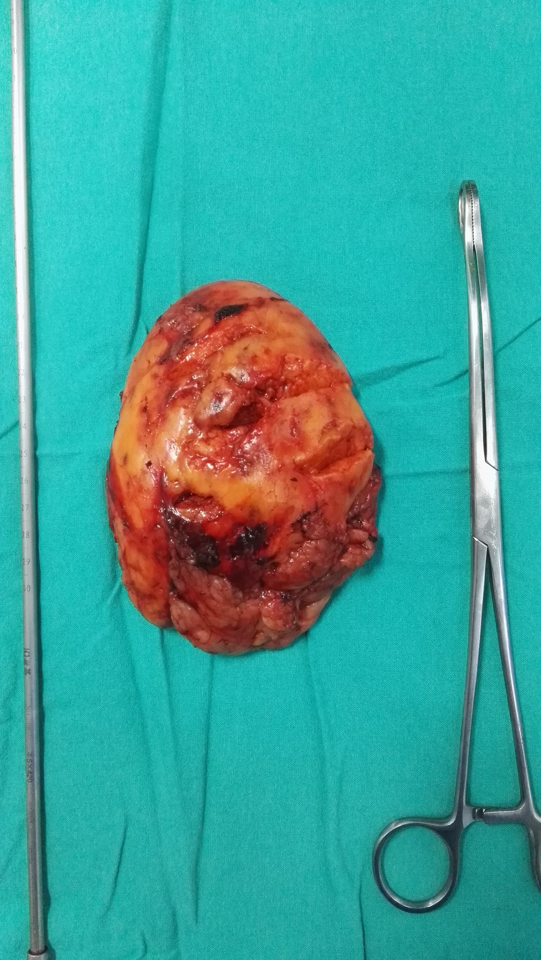 巨大的肾错构瘤哪些可以微创手术保留肾脏