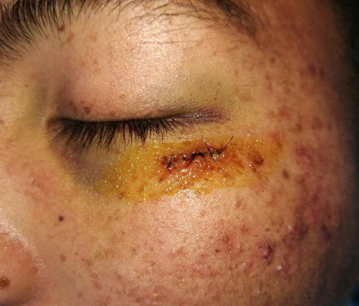 表皮囊肿是什么