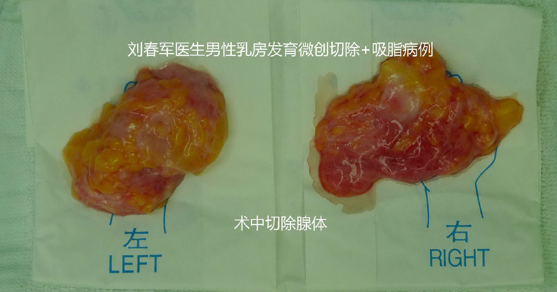 原创男性乳房发育手术问答与护理附多组病例效果