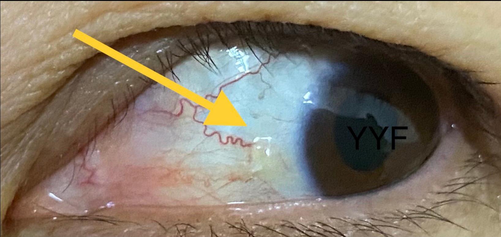 来自搜狗图片但毕竟病变和常规的翼状胬肉和睑裂斑表现有很大的差异