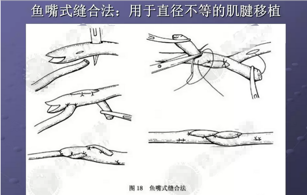 肌腱韧带损伤肌腱缝合的原则和方法汇总