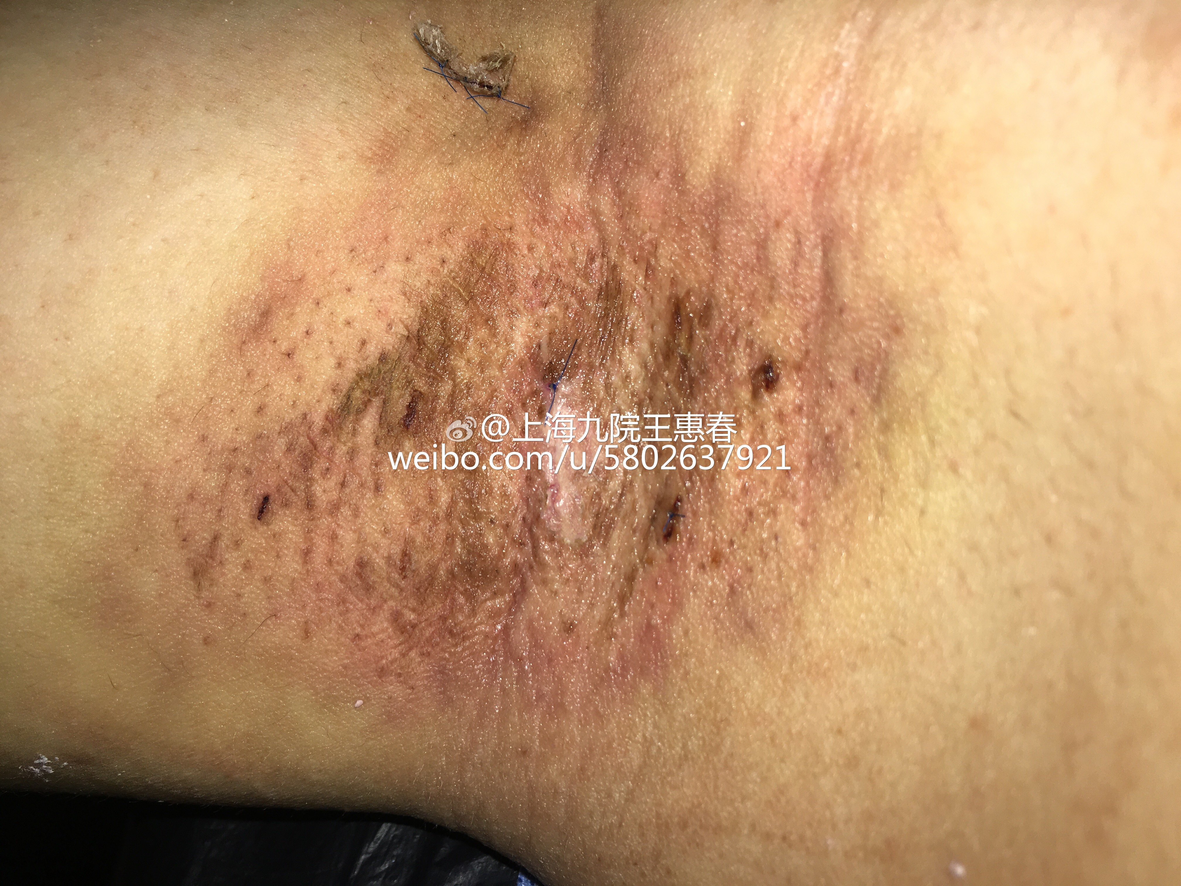 腋臭术后2周拆线如何不用刀剪