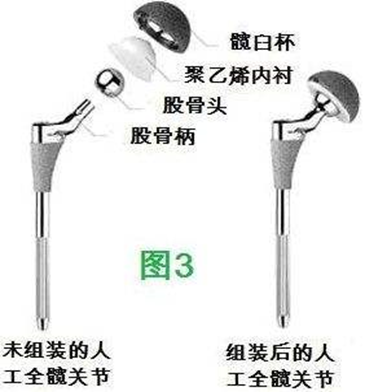 髋关节假体的柄和髋臼外杯主要是钛合金材料,股骨近端安放的股骨头分