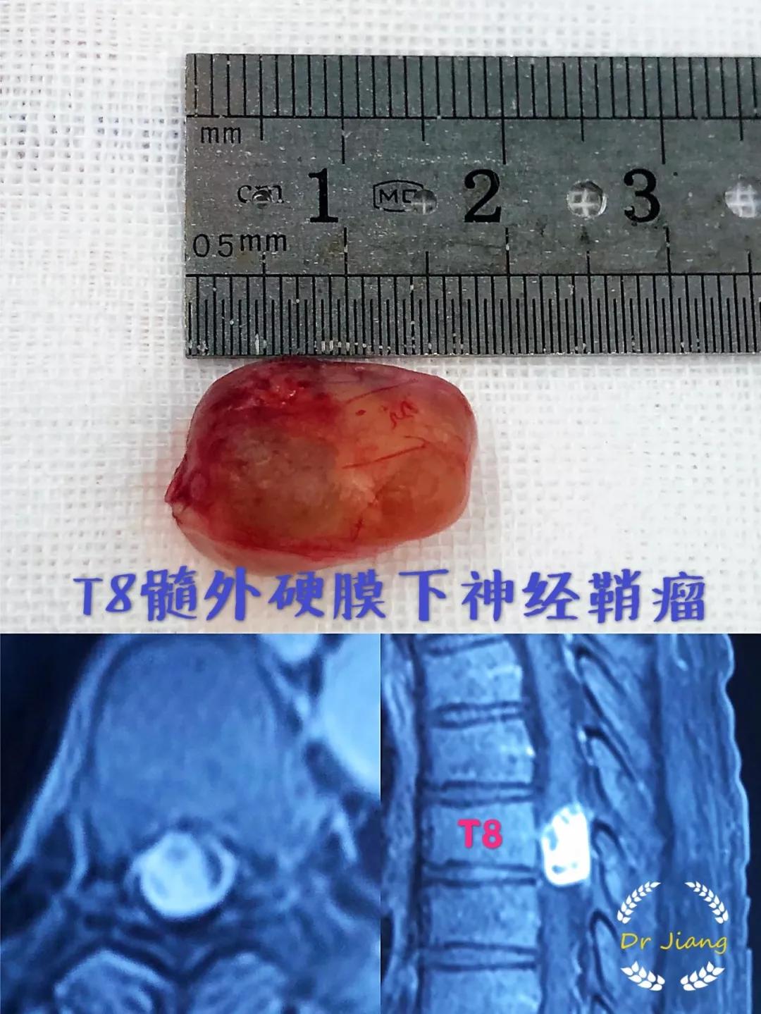 确诊患者为t8椎管内髓外硬膜下神经鞘瘤后,经患者和家属同意后尽快