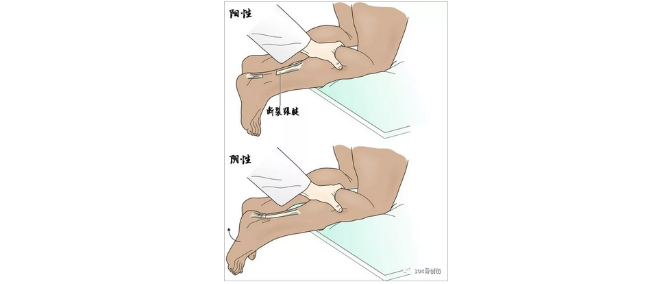 肌腱跟腱thompson试验发现之谜