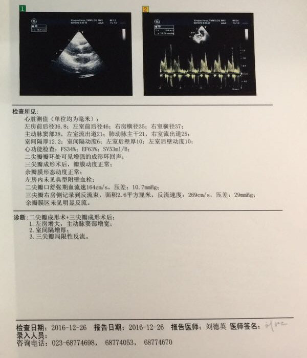 二尖瓣关闭不全是直接换瓣还是先考虑成形修复