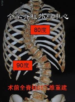 第25例脊柱侧弯典型病例女14岁80和90度s弯术后纠正满意