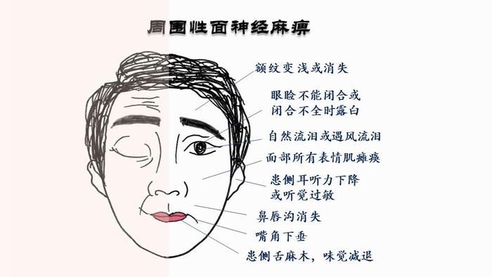 周围性面神经麻痹引起面部的肌肉瘫痪,给患者生活和工作都带来极大