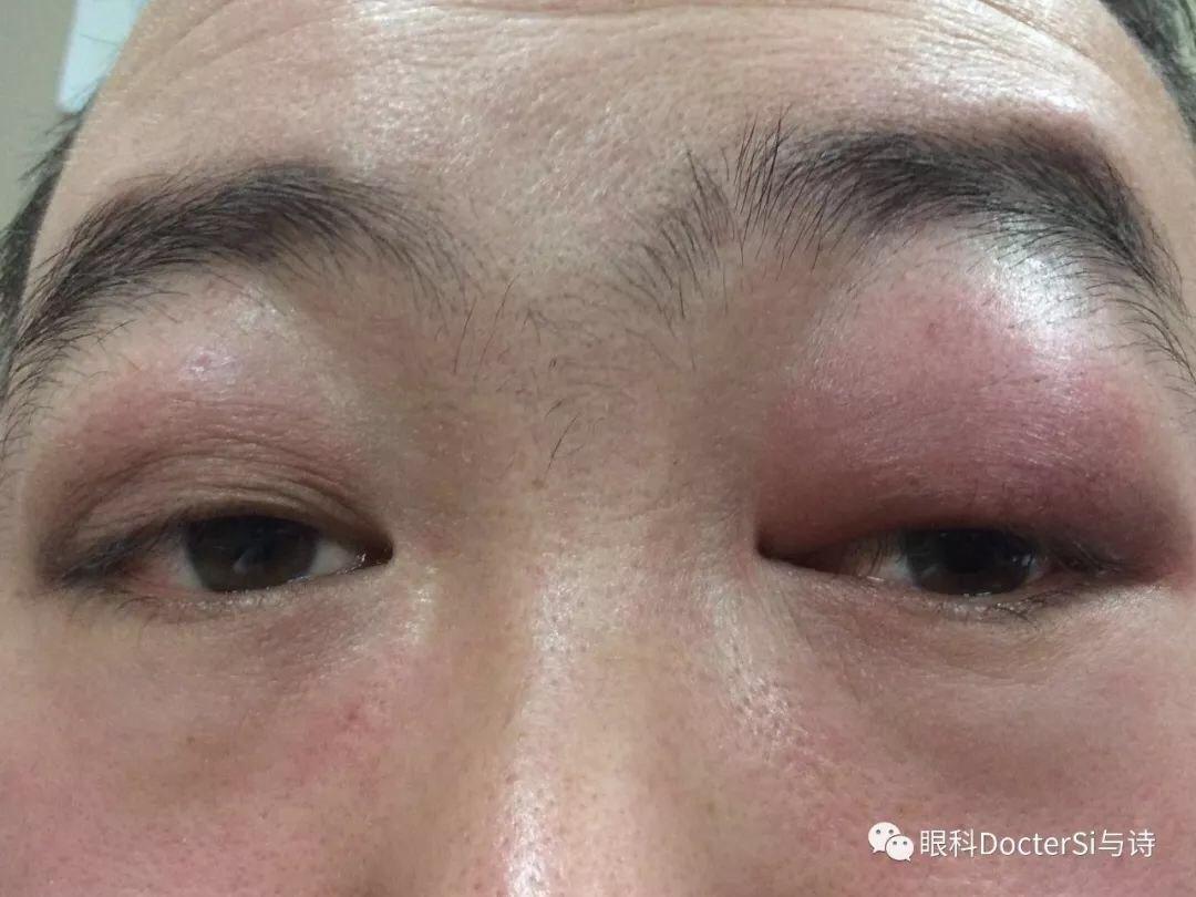 泪腺炎科普诗_司山成医生文章_北京清华长庚医院-微医