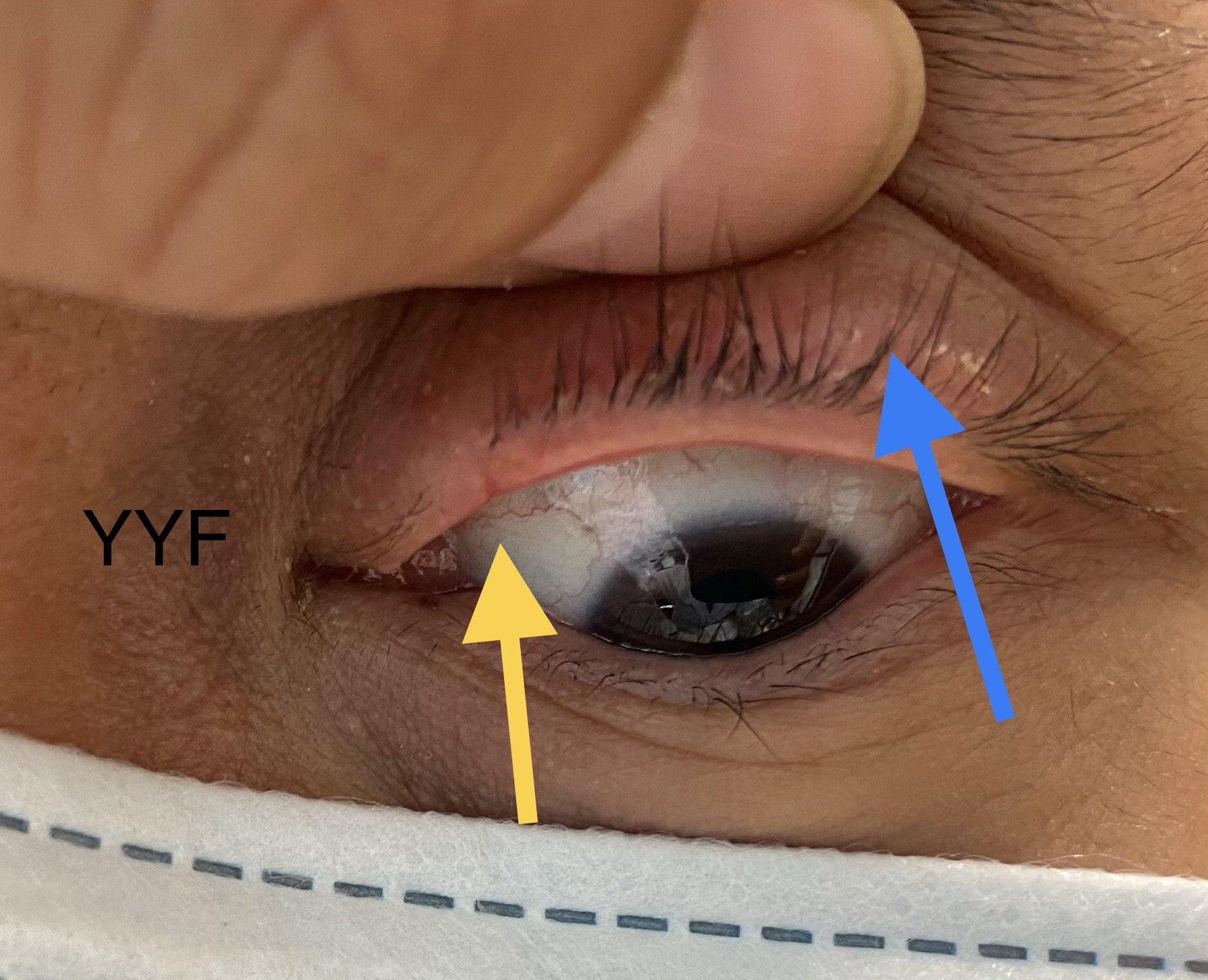 眼睑肿块系列之二睑缘霰粒肿手术宜早不宜迟