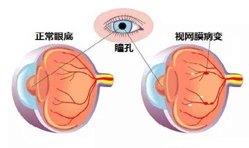 糖尿病视网膜病变是怎么一回事 健康号 微医