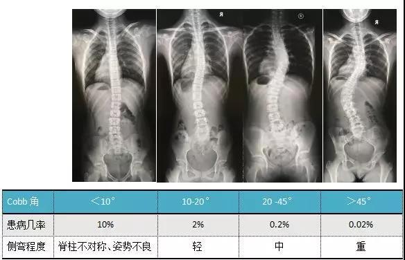 青少年脊柱侧弯