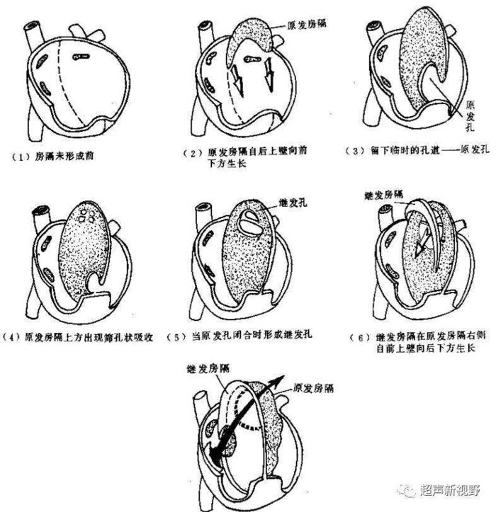 胚胎发育过程中,左,右心房之间残留未闭引起,多因房间隔的发生,吸收