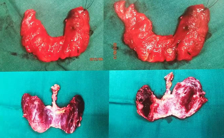 增加甲状腺球蛋白作为肿瘤标志物在检测肿瘤转移和复发中的作用