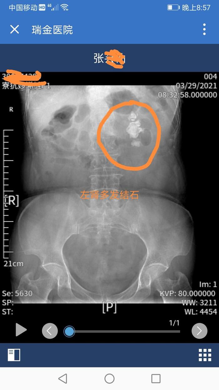 经皮肾镜碎石取石治疗复杂肾结石典型病例2