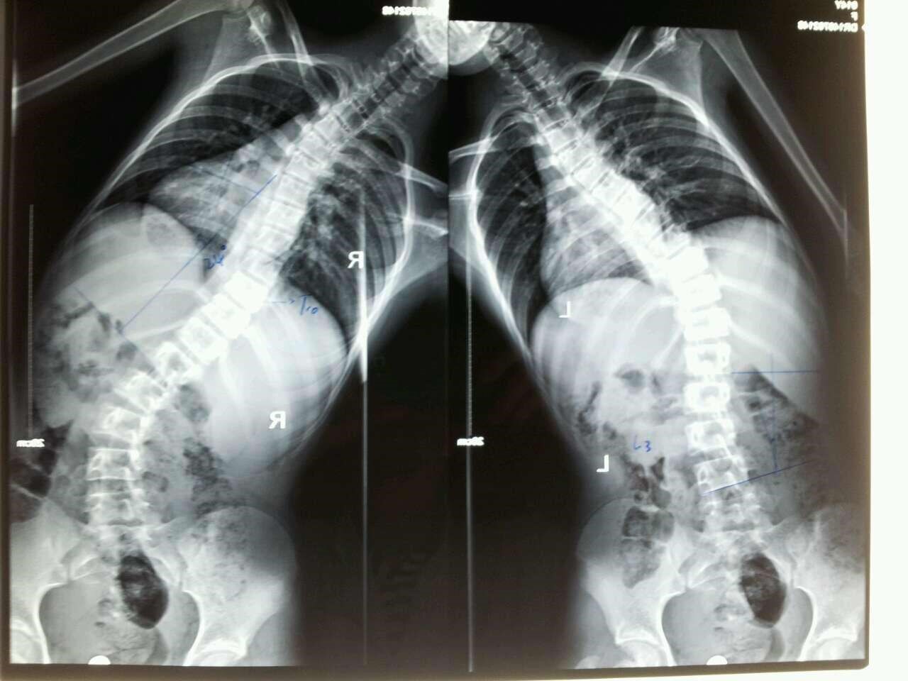 青少年特发性脊柱侧凸的家长手册及网上就医前注意事项